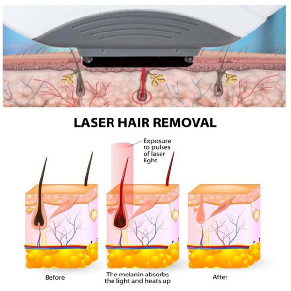 New Released KES Factory hair removal multifunction machine MED230/IPL and RF Hair Removal Machine