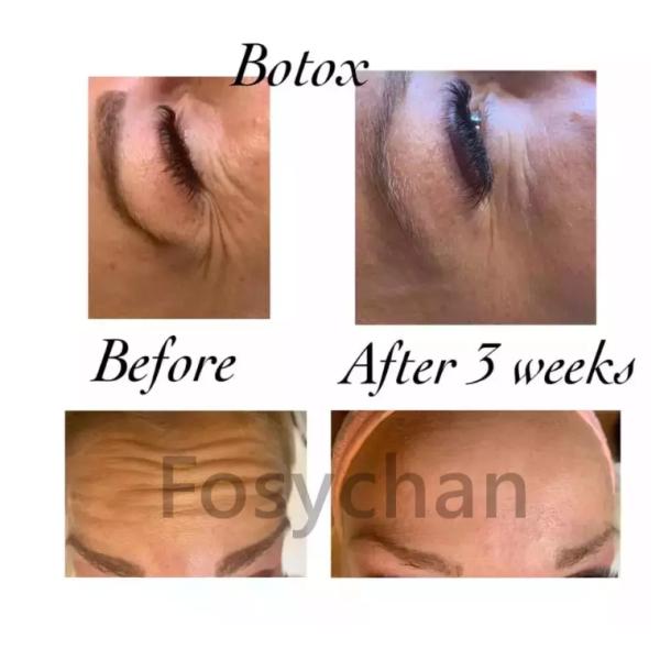 Acetil Botulinum Hexapeptide-3 da toxina do pó branco