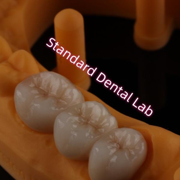 Puente de cerámica de porcelana de zircón de PFZ de alta transparencia en capas