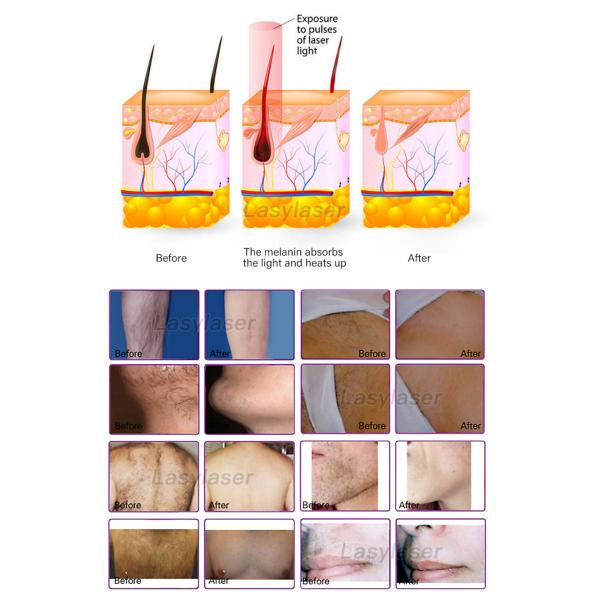 110-240V IPL Laser Hair Removal Machine SHR Alexandrite ND YAG Laser