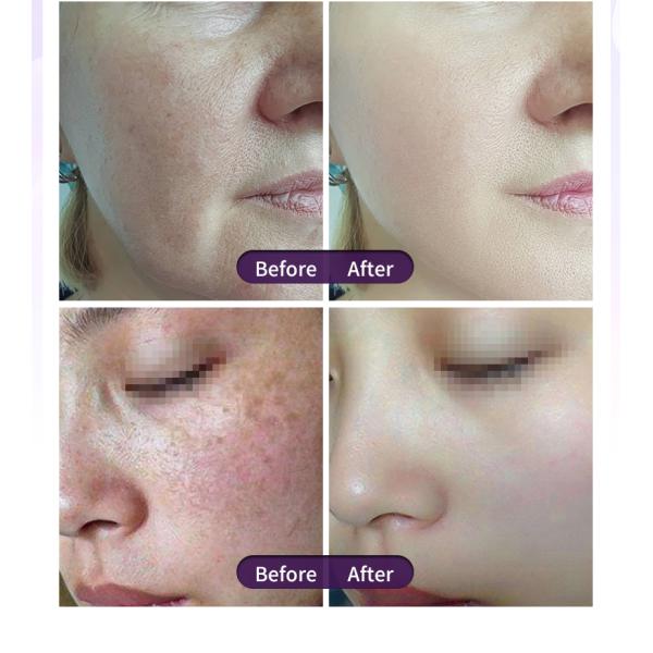STANDING Beauty Machine for Skin Rejuvenation and Diode Laser Hair Removal 755 808 1064nm