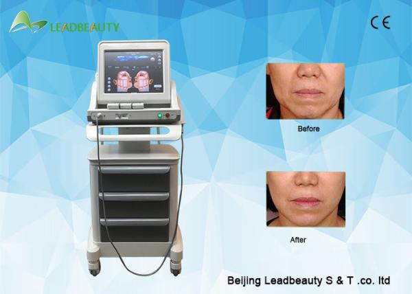 Good price Hifu High Intensity Ultrasound Face Lift Machine with 1.5mm, 3.0mm, 4.5mm and 13mm