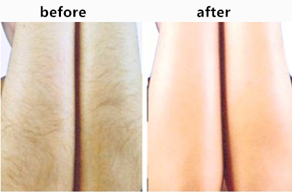 3 в 1 машине удаления волос Multfunction SHR для кожи затягивая, удаление татуировки