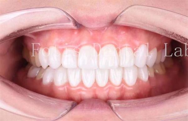High Translucency Dental Laminate Veneers Long Lasting Durability Polishing Finishing