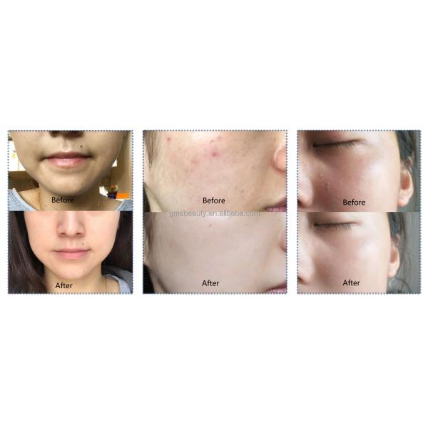 Opt Hair Removal Ipl Machine Face Acne Treatment Wrink Skin Rejuvenation Acne Clearance Portable Ipl M22 Beauty