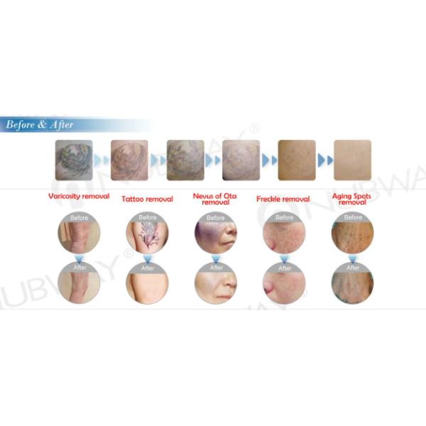 Hot sale laser spider vein removal spider veins removal beauty machine