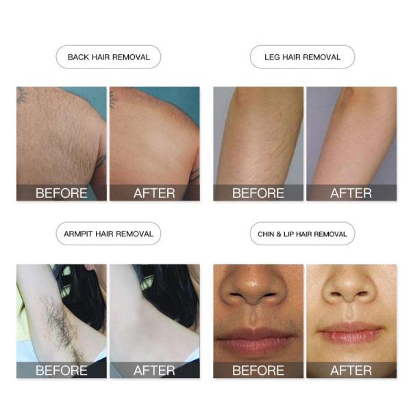 Отсутствие охлаждать полупроводника оборудования красоты лазера диода боли 808nm