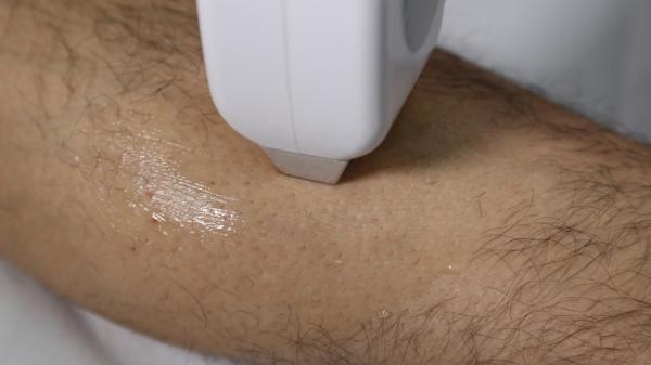 Alexandrite Diode Laser Hair Removal Machine 808