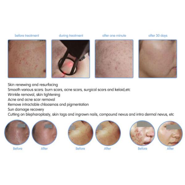 2017 new pixel rf co2 fractional laser /dermatological skin beauty machine