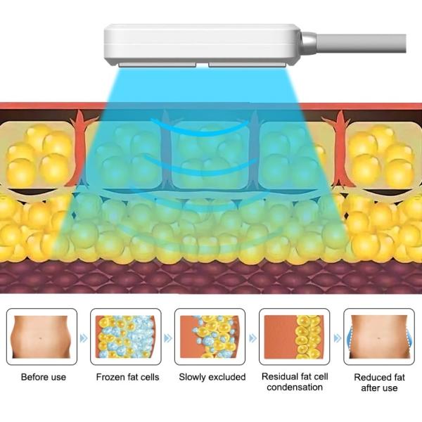 635nm Wavelength Beauty Apparatus Laser Slimming Cellulite Reduction Machine