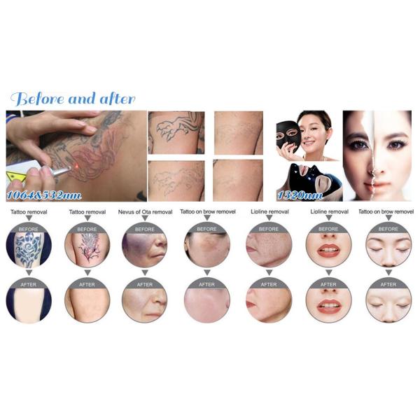 1064nm / 532nm Q Switch Tattoo Removal Machine , Stationary Tattoo Removing Equipment