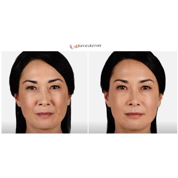 Заполнитель Juvederm Voluma впрыски соединенный крестом дермальный