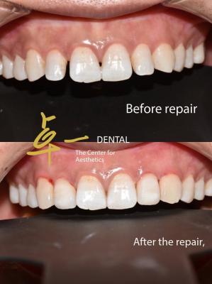 Say Hello To A Flawless Smile With Cosmetic Dental Veneers No Discoloration No Preparation