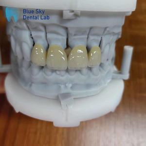 Circonia durable recouverte d'une couche de porcelaine couronne de circonie