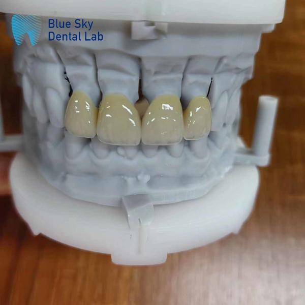 Durable Zirconia Layered With Porcelain Zirconia Multilayer Crown