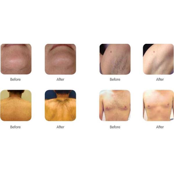 2000W diode laser hair removal machine with 12*20mm big spot size