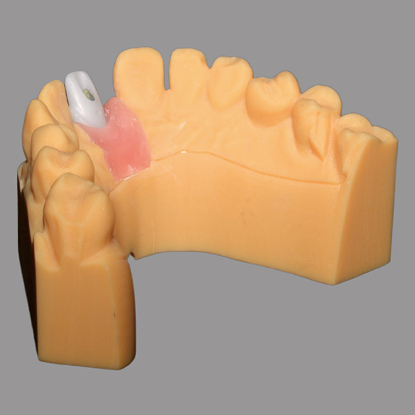 White Custom Zirconia Abutment Natural Looking For Dental Restoration