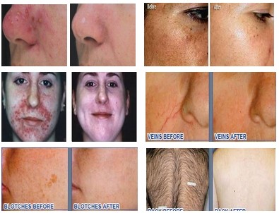 Best IPL SHR Elight Hair Removal Machine with medical ce certification