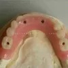 Choose China Dental Implants for Permanent and Reliable Solution to Missing Teeth with Wholesale Prices
