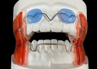Appareil d'orthodontie Frankel 2/3 pour améliorer l'alignement des mâchoires chez les enfants en croissance