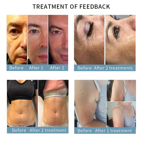 SMAS Layer Contouring Anti Wrinkle HIFU Beauty Machine Skin Rejuvenation