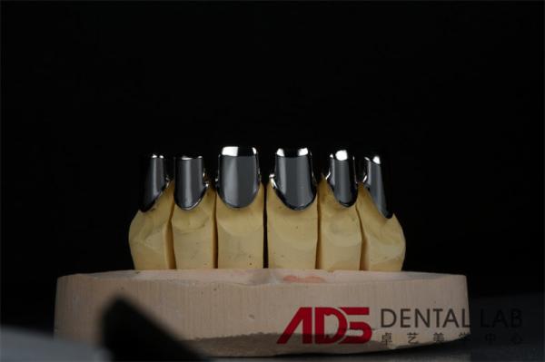Custom Metal precision Attachment Partial Denture Telescoper