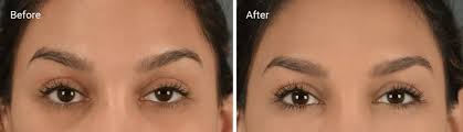 Кислота темных кругов Hyaluronic исключает решение Hyaluronate натрия сумки глаза сложное