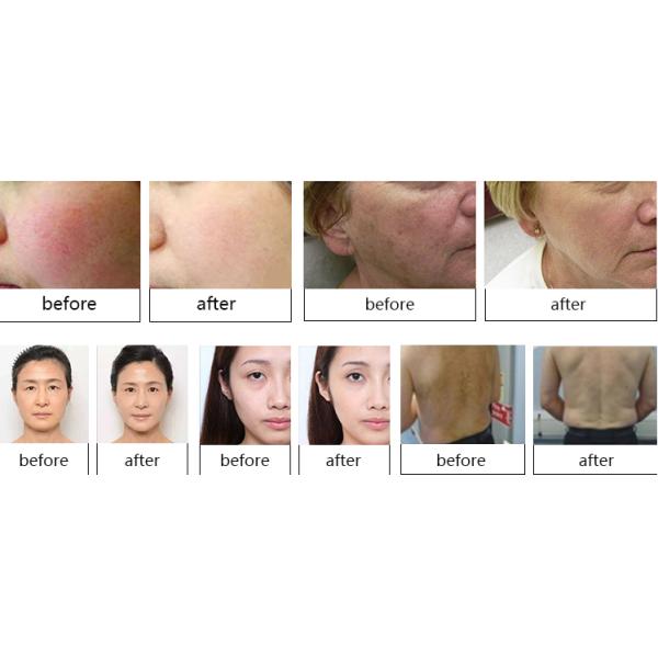 TUV Medical Laser Hair Removal Machines OPT Technology White / Grey Color