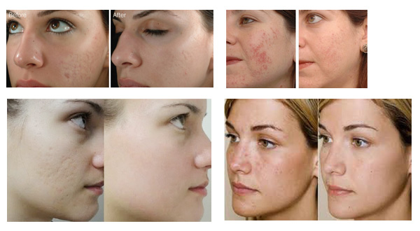 Dr. électrique meso professionnel Pen Derma de traitement de perte des cheveux de stylo de Microneedle