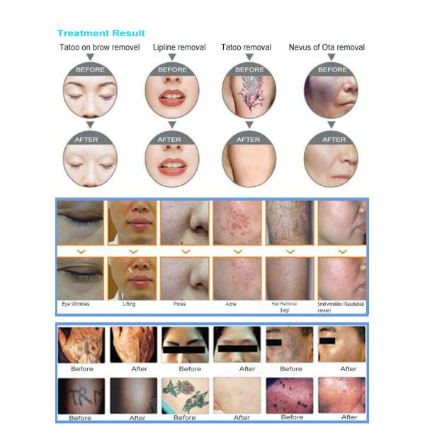 Мини машина 1064nm 532nm 1320nm удаления татуировки лазера Nd Yag переключателя q