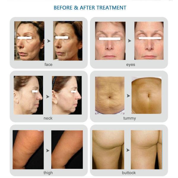 Штыри 49 горла 25 шеи прикалывают приборы RF Microneedling для дома