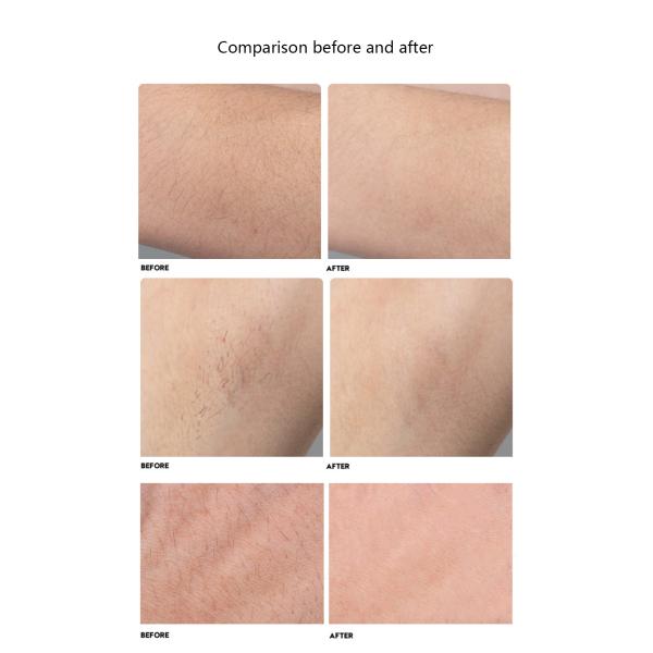 Home Use Hair Removal Beauty Machine 300W Diode Machine 808 Laser