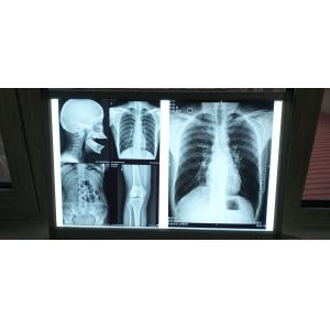 Medical X Ray Films