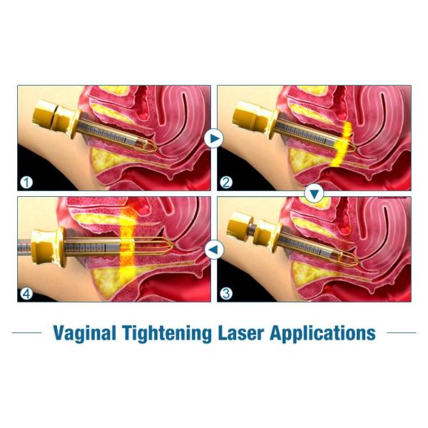 100% Pure Imported USA RF Tube Co2 Fractional Laser Machine Vaginal Tightening