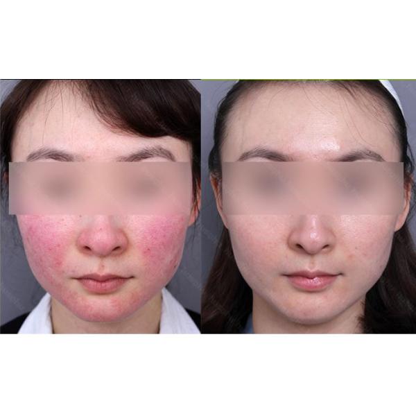 diode laser beauty equipment for couperose skin vascular treatment