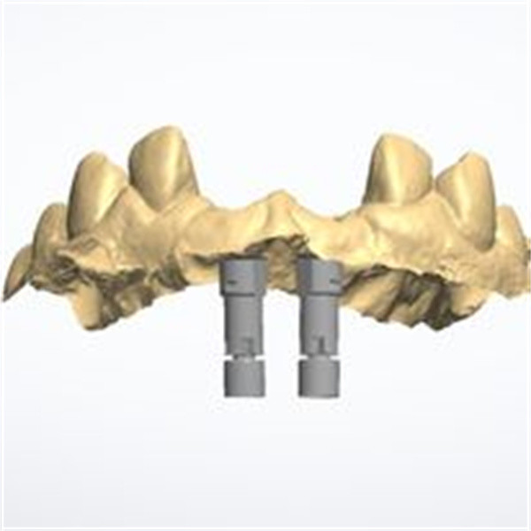 Customized 3D Model Zirconia Crown Offering Long-lasting Durability Designed To Meet The Needs Of Dental Professionals And Laboratories