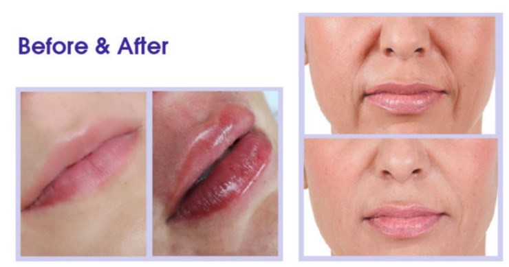 Впрыска 24mg/ml HA дермального заполнителя Fosyderm Hyaluronic кисловочная для CE губ