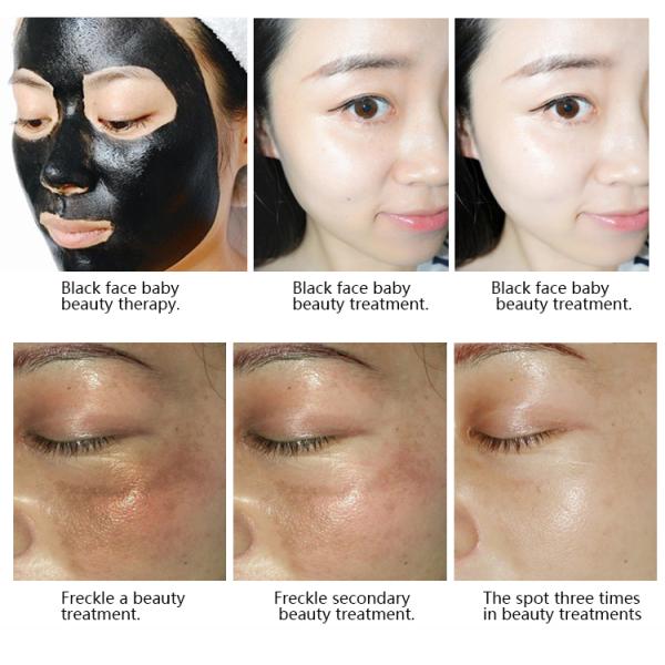 Vertical Type Nd Yag Laser Tattoo Removal Machine 1064 / 532nm Available