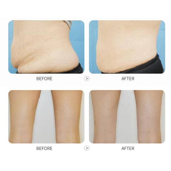 Home Use Mini Cryo Fat Freezing Weight Loss Equipment