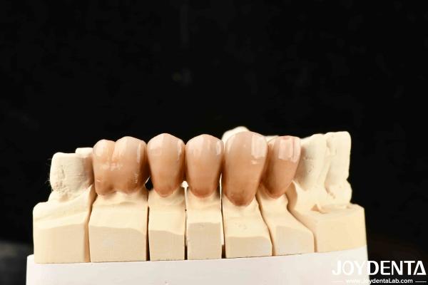 Bionic Development Leaves And Distinct Layers Of Zirconia All-Ceramic