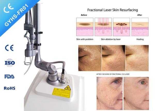 Clinic vaginal Laser Machines fractional CO2 ance scar removal laser Without Side - Effects