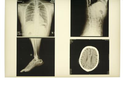 28cm * 35cm Medical Film Xray Paper For KND-DRYTEC-3000 Laser Printer