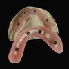 Choose China Dental Implants for Permanent and Reliable Solution to Missing Teeth with Wholesale Prices