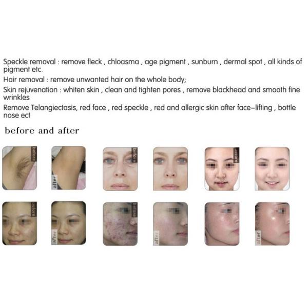 Multifunction 2000W E-light IPL RF Laser Hair Removal Machine , SHR IPL Machine