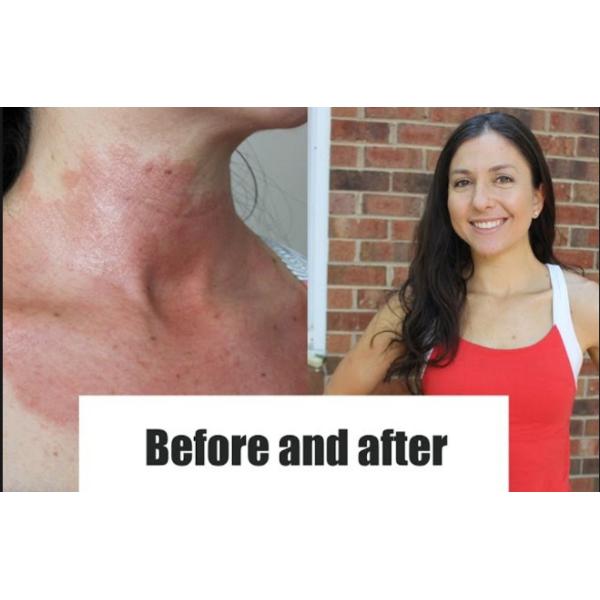 UVB Phototherapy Light Therapy Treatment For Psoriasis