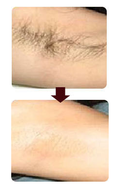 Permanent 808nm Diode Laser Hair Removal Machine with 1 - 10 HZ Frequency