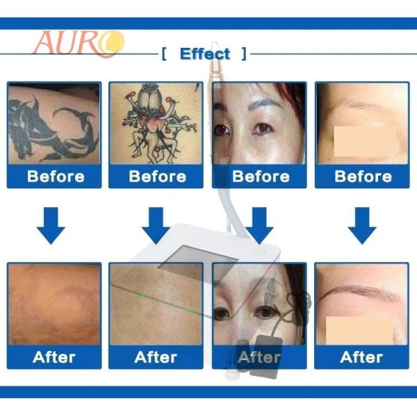 Laser Tattoo Removal Beauty Machine Skin Whitening 1320nm 1064nm 532nm