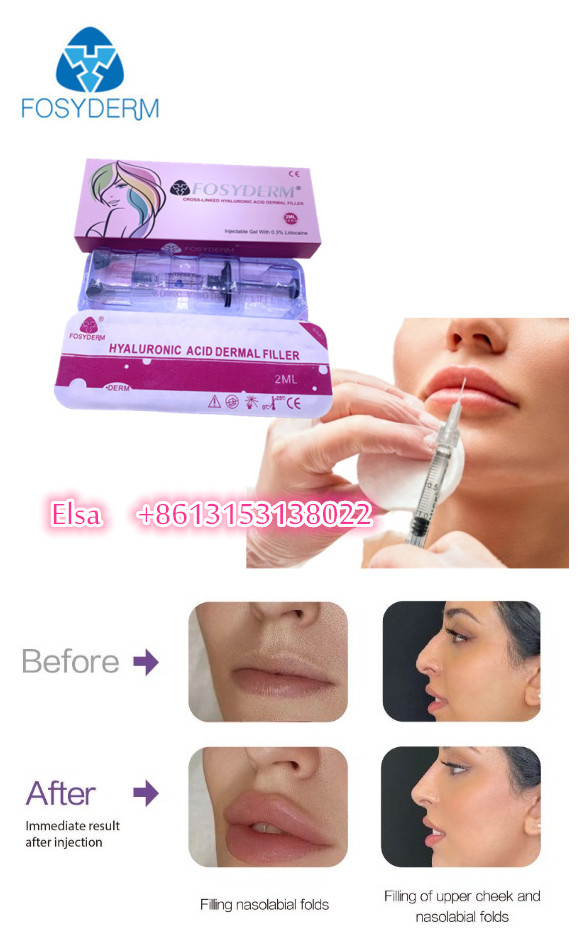 Hyaluronic кисловочный заполнитель Fosyderm дермальный для впрыски 24mg/Ml губ стороны