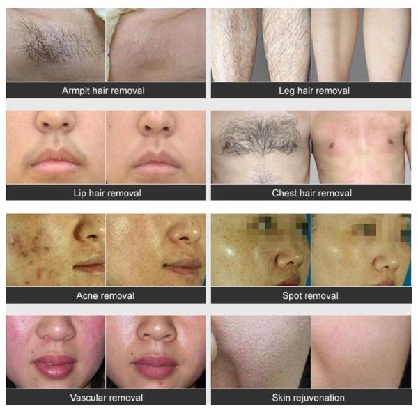 Portable IPL OPT SHR Hair Removal Machine Multi Functional For Beauty Salon