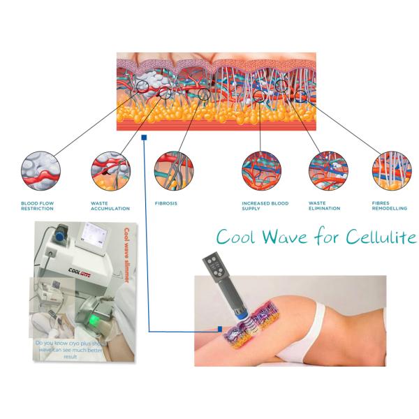 Машина Cryolipolysis крутой волны жирная замерзая на облегчение боли 1-16 Hz частоты